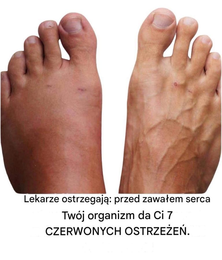 7_objaw_w_zawa_u_serca__na_kt_re_prawie_nikt_nie_zwraca_uwagi__dop_ki_nie_jest_za_p__no_-2