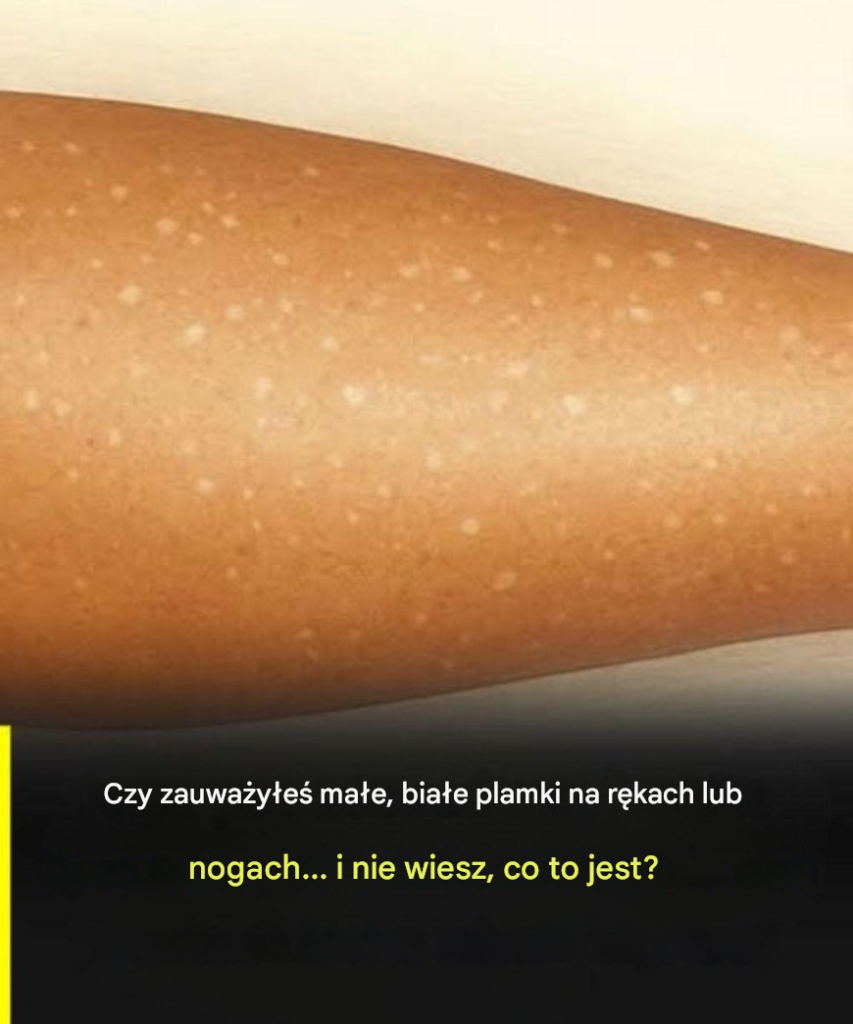 Bia_e_plamy_na_sk_rze__Niedobory_jakich_witamin_mog__by__przyczyn__ Bia_e_plamy_na_sk_rze__Niedobory_jakich_witamin_mog__by__przyczyn__