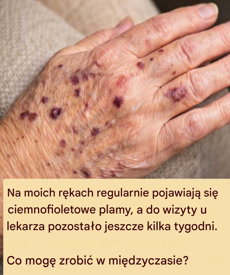 Ciemnofioletowe_plamy_na_r_kach__co_robi__w_oczekiwaniu_na_wizyt__u_lekarza_