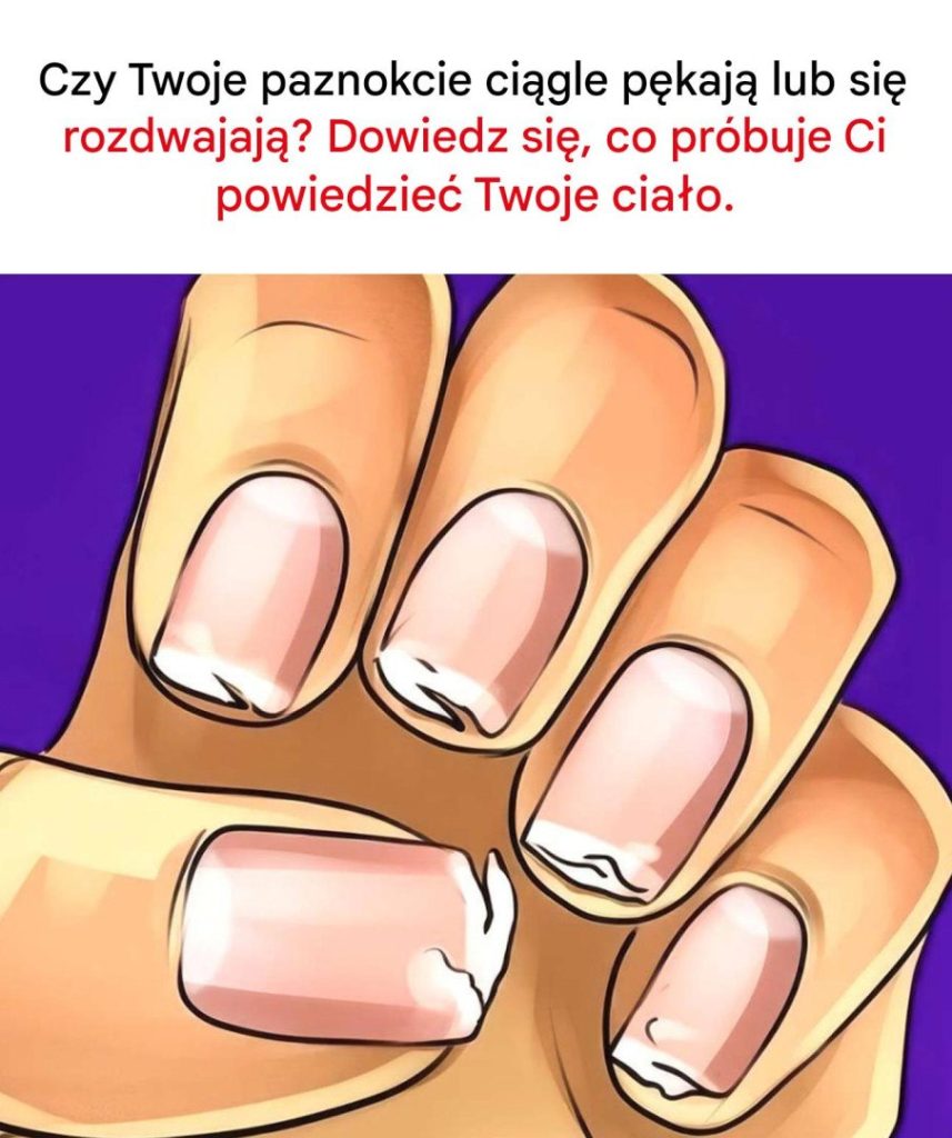 Czy_Twoje_paznokcie_s___amliwe__p_kaj__lub_rozdwajaj__si__regularnie__To_nie_jest_b_ahostka__Twoje_cia_o_wysy_a_Ci_sygna__ Czy_Twoje_paznokcie_s___amliwe__p_kaj__lub_rozdwajaj__si__regularnie__To_nie_jest_b_ahostka__Twoje_cia_o_wysy_a_Ci_sygna__
