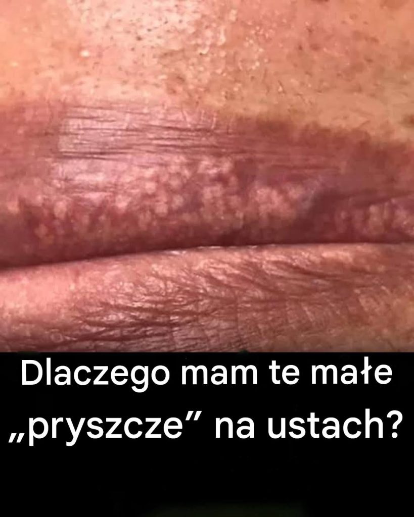 Dlaczego_na_moich_ustach_pojawiaj__si___pryszcze___czym_s__i_jak_sobie_z_nimi_radzi__-1