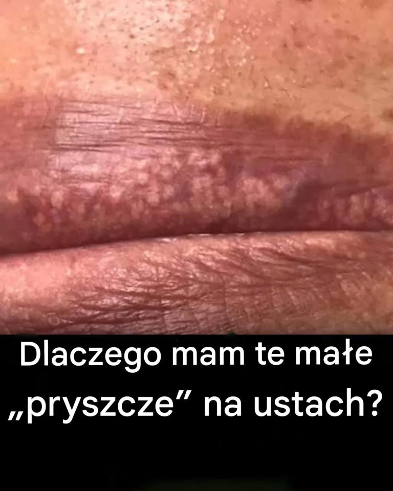 Dlaczego_na_moich_ustach_pojawiaj__si___pryszcze___czym_s__i_jak_sobie_z_nimi_radzi__