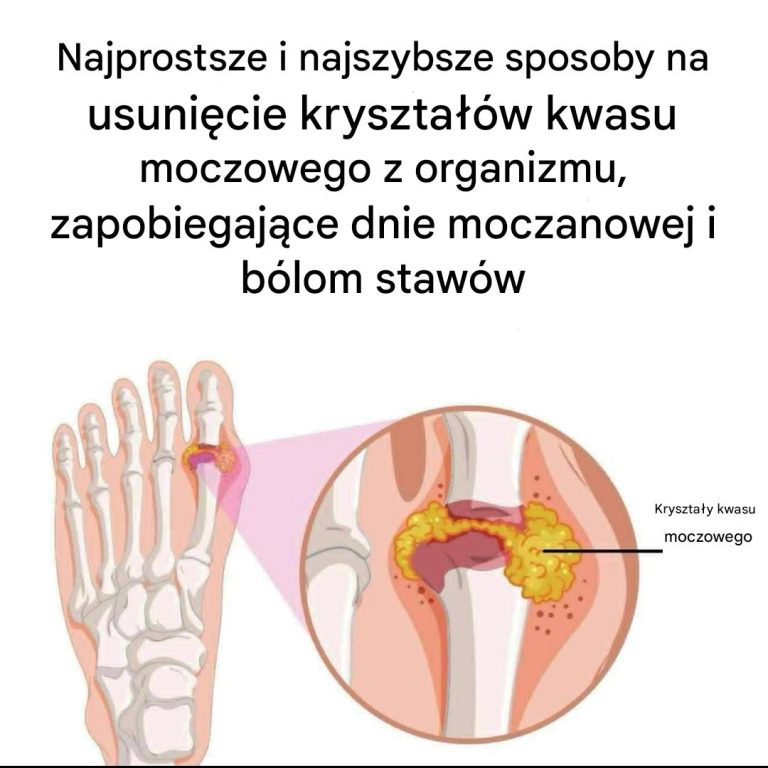 Jak_naturalnie_z_agodzi__dn__moczanow__i_b_l_staw_w