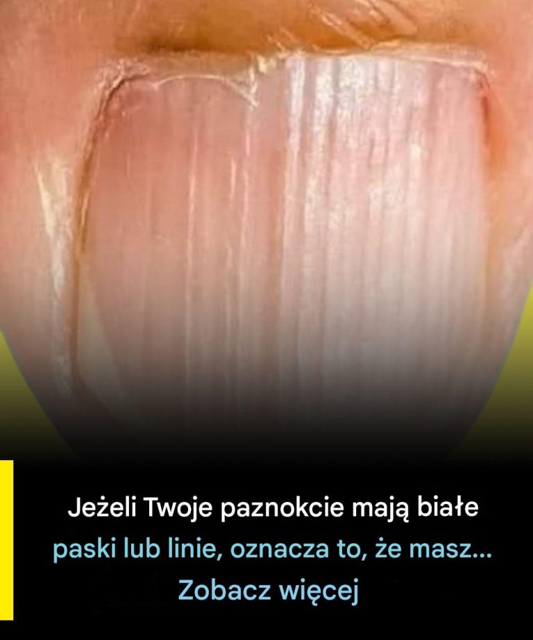 Kiedy_bia_e_linie_na_paznokciach_mog__by__oznak__problemu_zdrowotnego