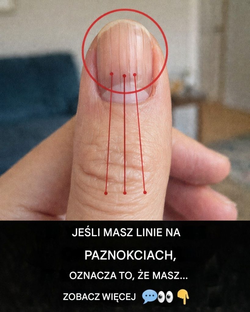 Linie_na_paznokciach__co_mog__m_wi__o_Twoim_zdrowiu Linie_na_paznokciach__co_mog__m_wi__o_Twoim_zdrowiu