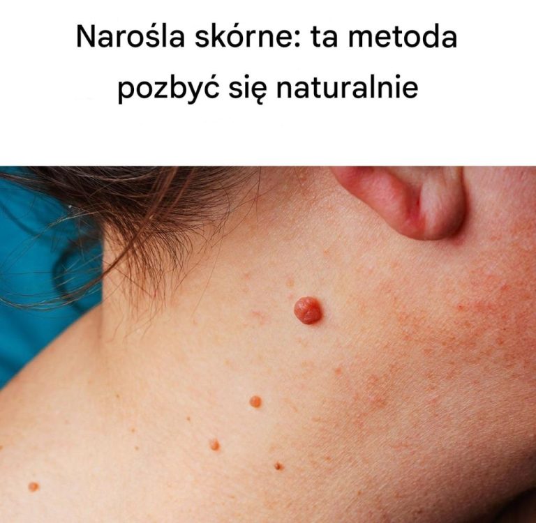 Naro_la_sk_rne__jak_pozby__si__ich_naturalnie