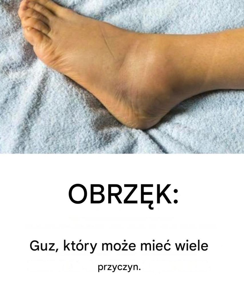 Obrz_k__objawy__przyczyny_i_leczenie_ Obrz_k__objawy__przyczyny_i_leczenie_