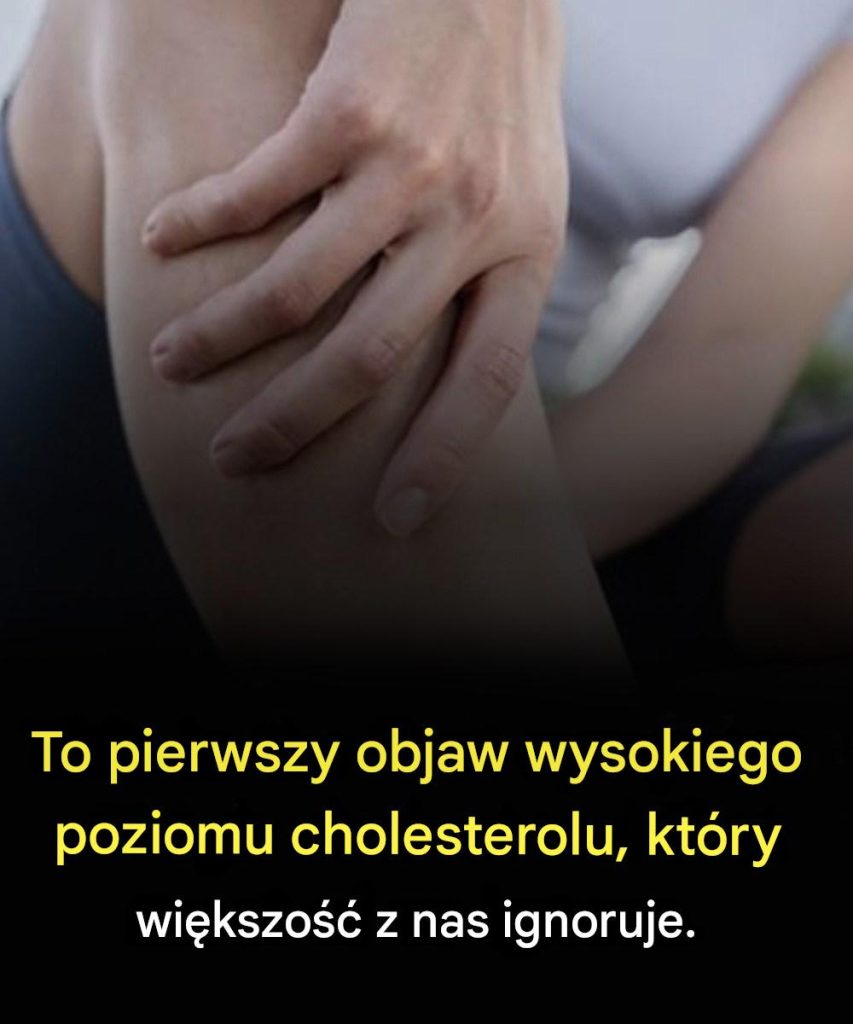 To_pierwszy_objaw_wysokiego_poziomu_cholesterolu__kt_ry_wi_kszo___z_nas_ignoruje_