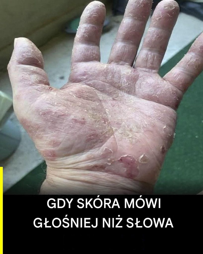 Zapalenie_sk_ry_d_oni__cichy_sygna___kt_ry_Twoja_sk_ra_wysy_a_ka_dego_dnia_-1