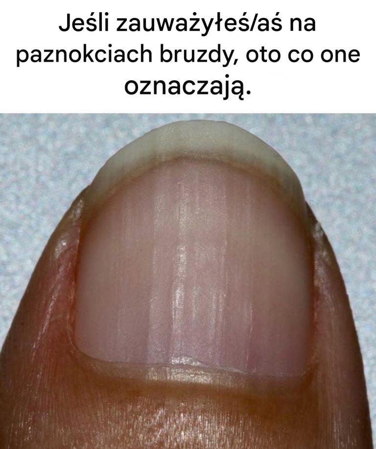 Je_li_zauwa_y_e__a__na_paznokciach_bruzdy__oto_co_one_oznaczaj__