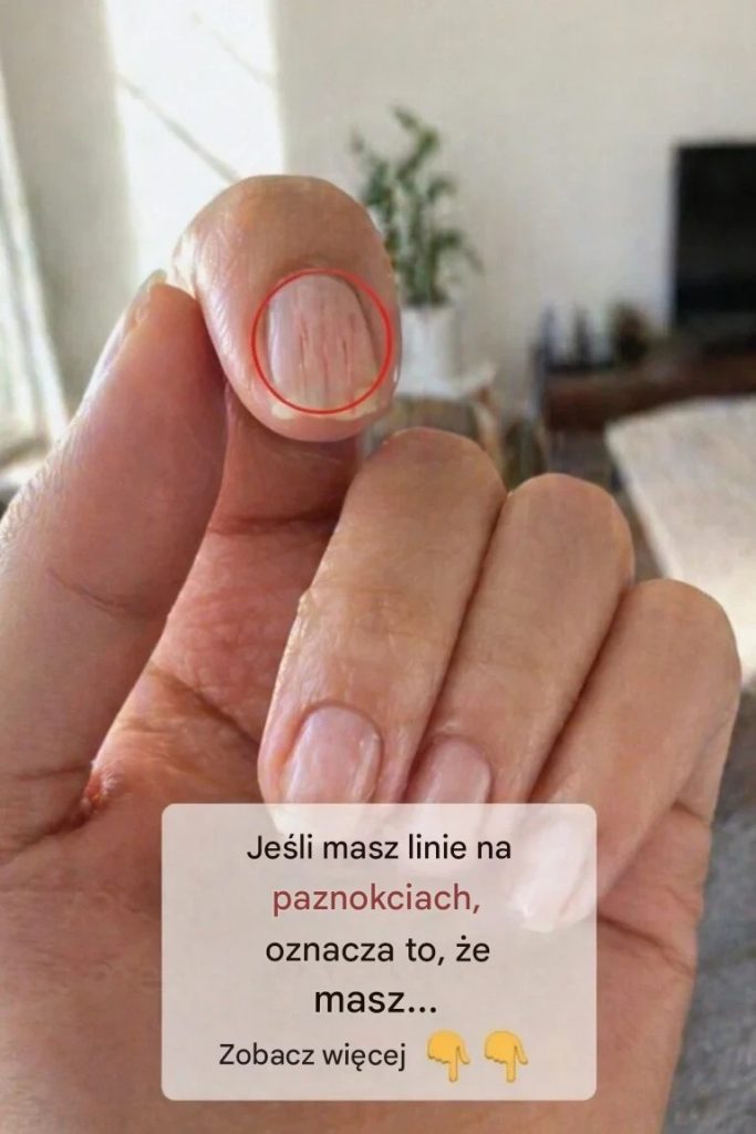 Co_te_pionowe_grzbiety_i_poziome_linie_na_paznokciach_mog__m_wi__o_Twoim_ciele-1 Co_te_pionowe_grzbiety_i_poziome_linie_na_paznokciach_mog__m_wi__o_Twoim_ciele-1