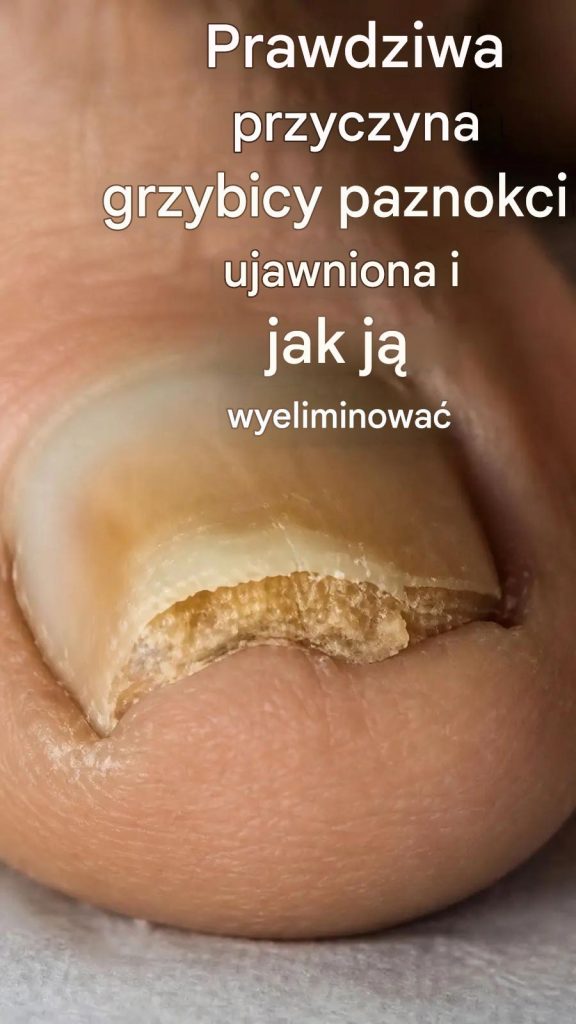 Trwale_pozb_d__si__grzybicy_paznokci_za_pomoc__2_naturalnych_sk_adnik_w_
