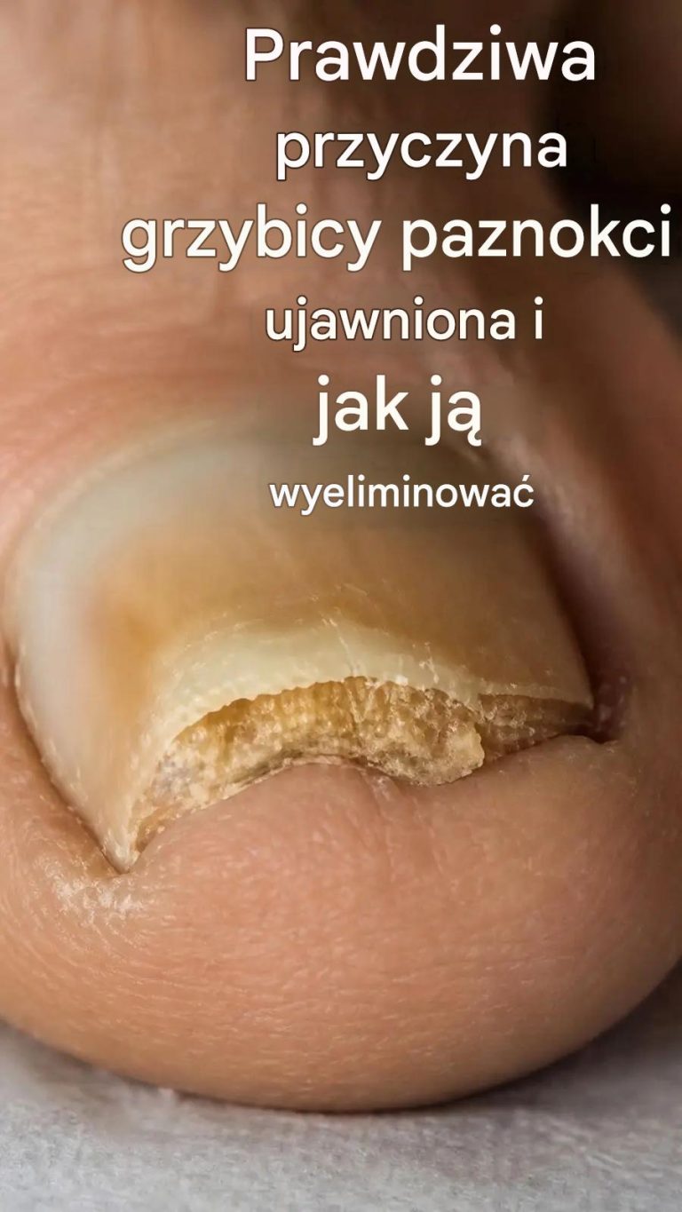Trwale_pozb_d__si__grzybicy_paznokci_za_pomoc__2_naturalnych_sk_adnik_w_