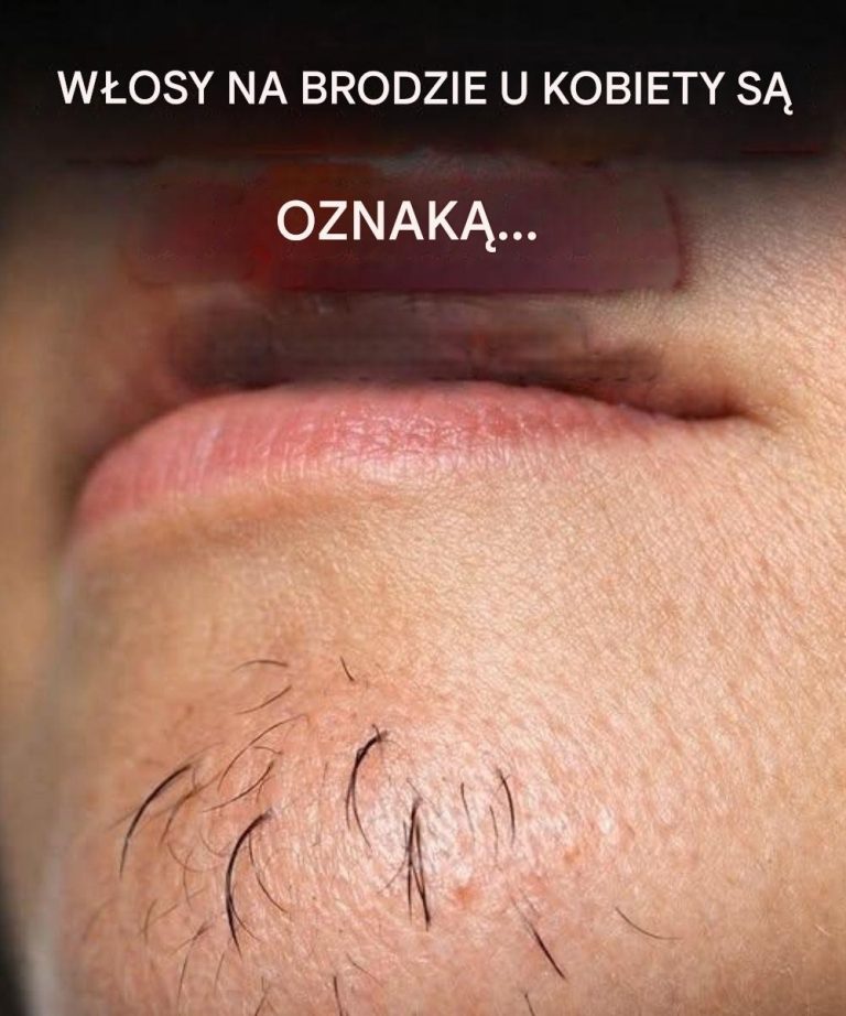 W_osy_na_brodzie_u_kobiety_s__oznak__Zobacz_wi_cej-1